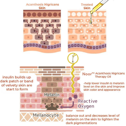 Acanthosis Nigricans Therapy Oil