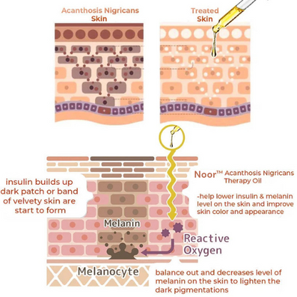 Acanthosis Nigricans Therapy Oil